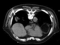 CT_cross-section_needle_lungnodule