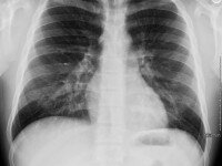 X-ray_chest