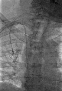 X-ray showing placement of a central venous catheter in the Jugular vein for chemotherapy treatments.