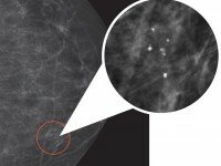 Mammogram - shows calcifications, an early sign of breast cancer