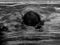 ultrasound_breast_clearcyst.png